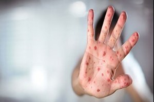 معاون بهداشت دانشگاه جندی شاپور مطرح کرد: افزایش موارد ابتلا به سرخک در خوزستان در ماه‌های اخیر