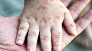تست آنتیبادی ضد سرخک هیچ مبنای علمی ندارد