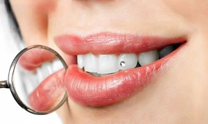 بلایی که کاشت نگین بر سر دندان میآورد